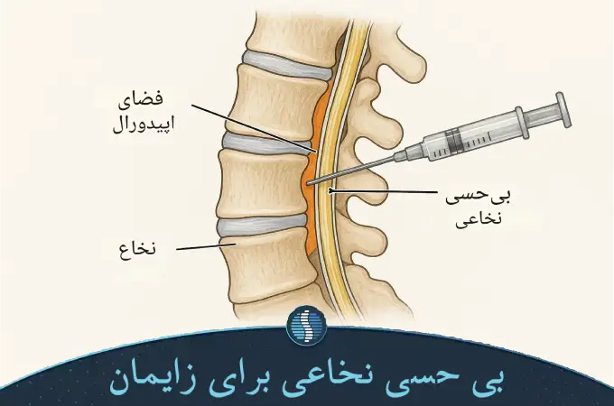 بی حسی نخاعی برای زایمان