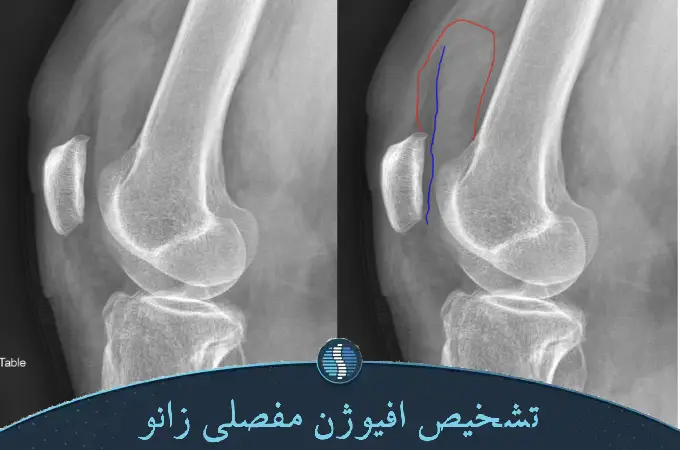 تشخیص افیوژن مفصلی زانو