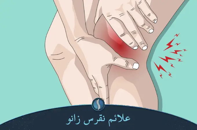 علائم نقرس زانو