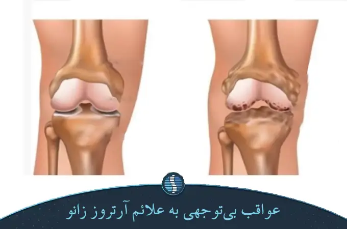 عواقب بی_توجهی به علائم آرتروز زانو