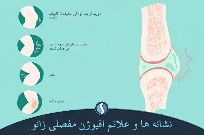 نشانه ها و علائم افیوژن مفصلی زانو