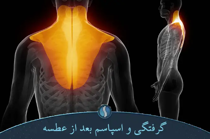 گرفتگی و اسپاسم بعد از عطسه