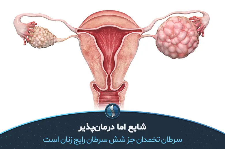 سرطان تخمدان، در کار تخمدان‌ها خلل ایجاد می‌کند| ژین طب