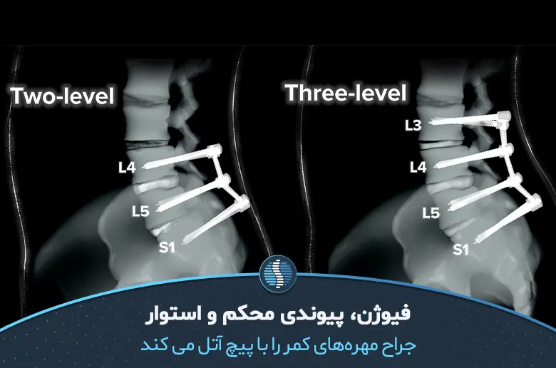 در روش فیوژن مهرههای کمر رابه هم آتل میکنند|ژین طب