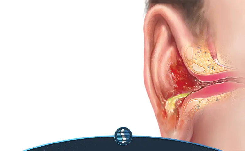 عفونت گوش | ژین طب