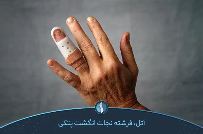 درمان انگشت چکشی دست با فیزیوتراپی؛ درمان با آتل