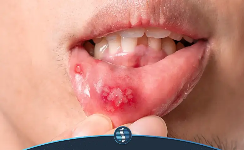 درمان آفت دهان با دیفن هیدرامین