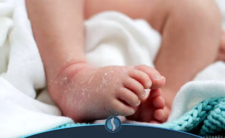 درمان خشکی پوست نوزاد برای رفع خارش و التهاب ناشی از آن|ژین طب