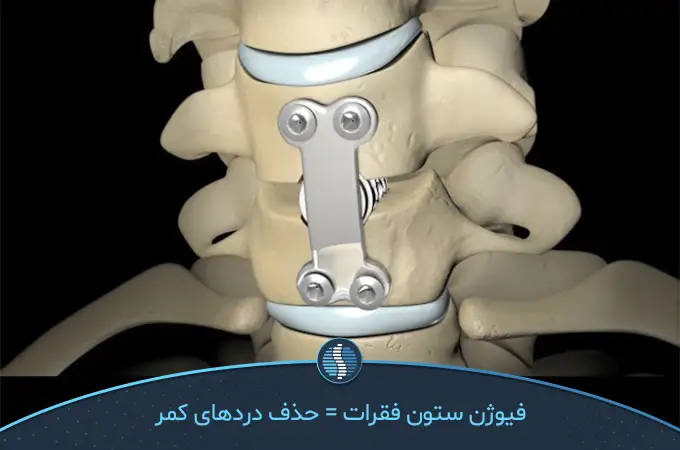 جراحی فیوژن ستون فقرات یا عمل دیسک کمر|ژین طب