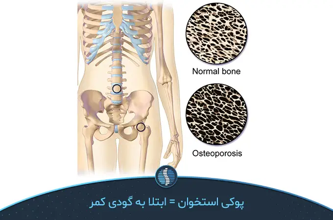 3.	ستون فقرات مبتلا به گودی کمر به دلیل پوکی استخوان|ژین طب