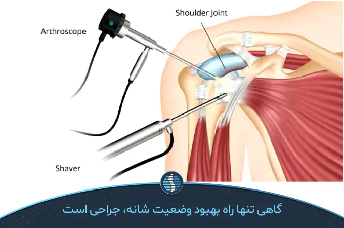 جراحی آرتروسکوپی برای درمان التهاب مفصل شانه|ژین طب