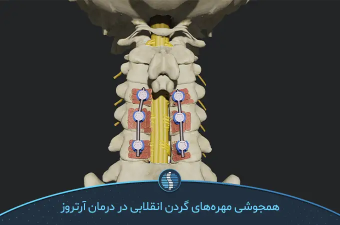 جراحی فیوژن ستون فقرات روشی برای درمان آرتروز گردن|ژین طب