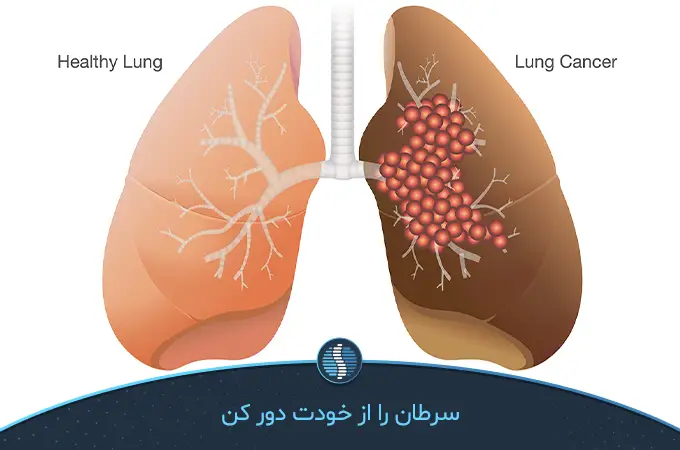 ریه مبتلا به سرطان و ریه سالم در یک قاب از مضرات سیگار الکترونیکی|ژین طب