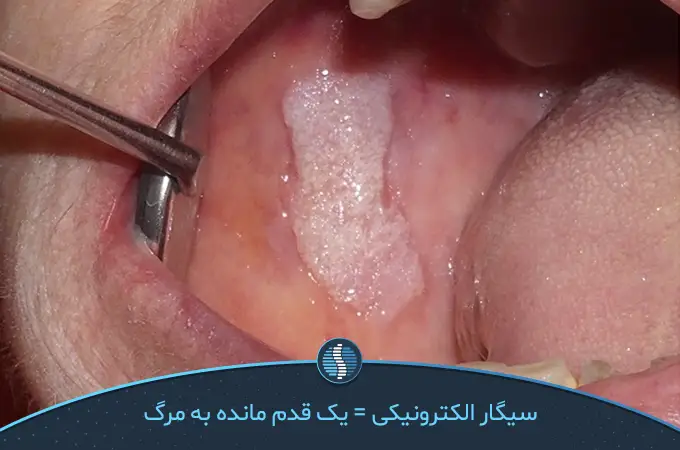 سرطان دهان از مضرات ویپ|ژین طب