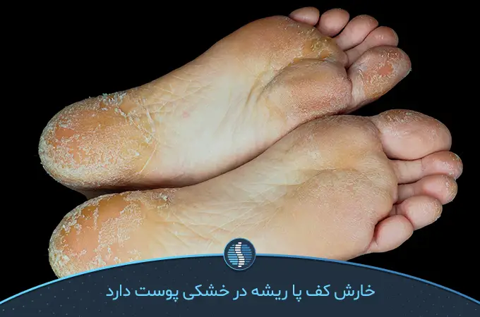 خشکی پوست علت خارش کف پا|ژین طب