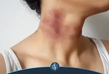 کبودی گردن | ژین طب
