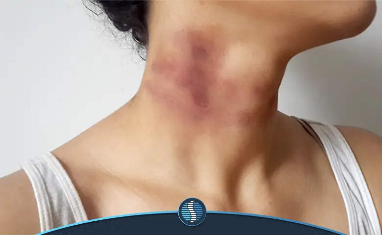 کبودی گردن | ژین طب