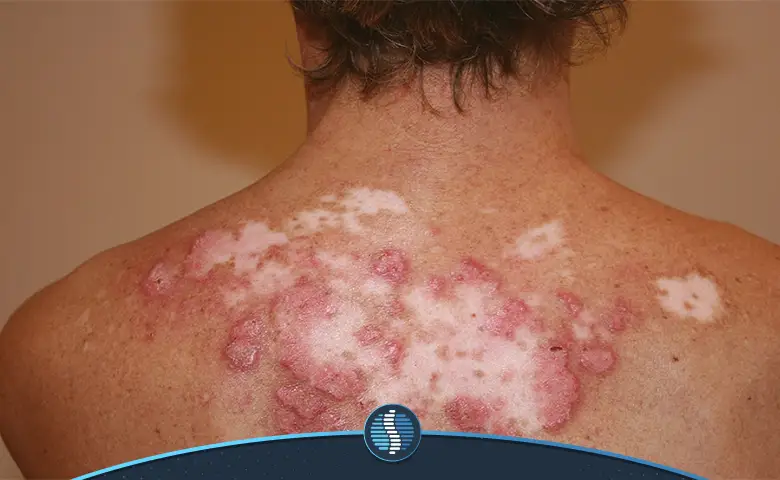 زخم و لکه‌های پشت و گردن به دلیل بیماری لوپوس پوستی|ژین طب