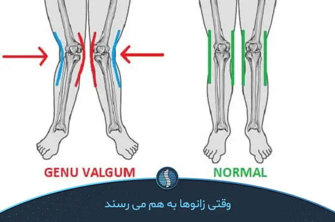 تفاوت آناتومی در پای سالم و پای ضربدری  | ژین طب