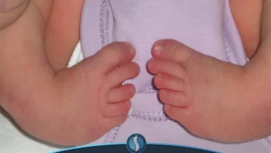 پای پرانتزی در کودکان و نوزادان قابل درمان است|ژین طب