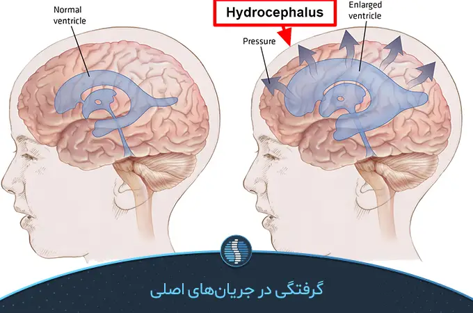 هیدروسفالی در اثر جمع شدن مایع مغزی نخاعی در جمجمه ایجاد می‌شود
