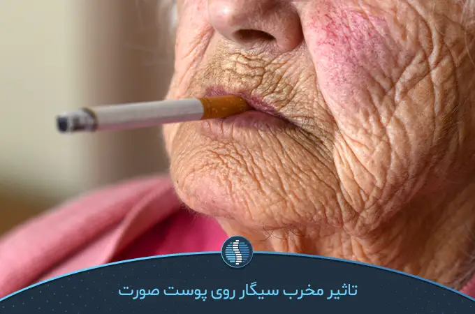 افتادگی پوست صورت به دلیل مصرف سیگار|ژین طب