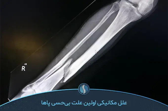 شکستگی استخوان‌ ساق پا که علت بی حس شدن پای راست از زانو به پایین است|ژین طب