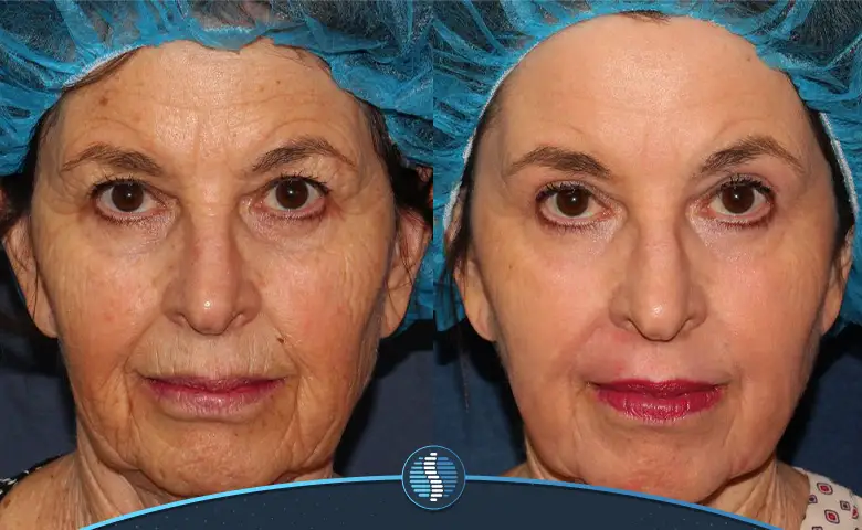قبل و بعد درمان چروک صورت با آر اف فرکشنال| ژین طب