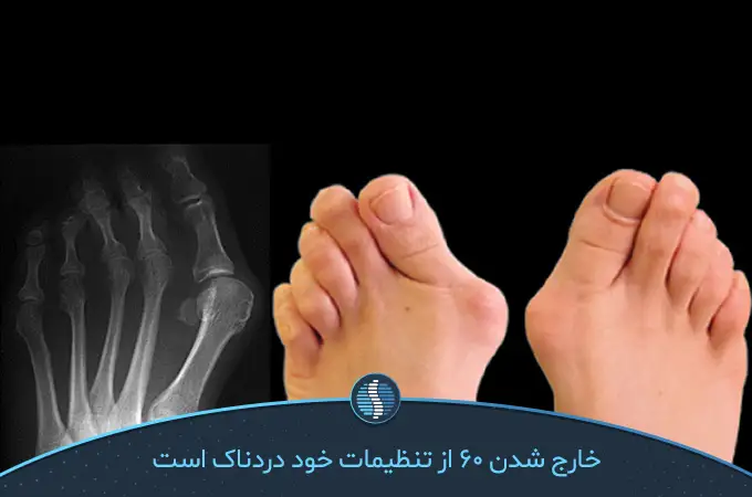 انحراف شست پا باعث بیرون زدن استخوان شست می‌شود|ژین طب
