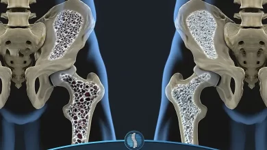 درمان پوکی استخوان یک روش موثر برای جلوگیری از خطرات بیشتر|ژین طب
