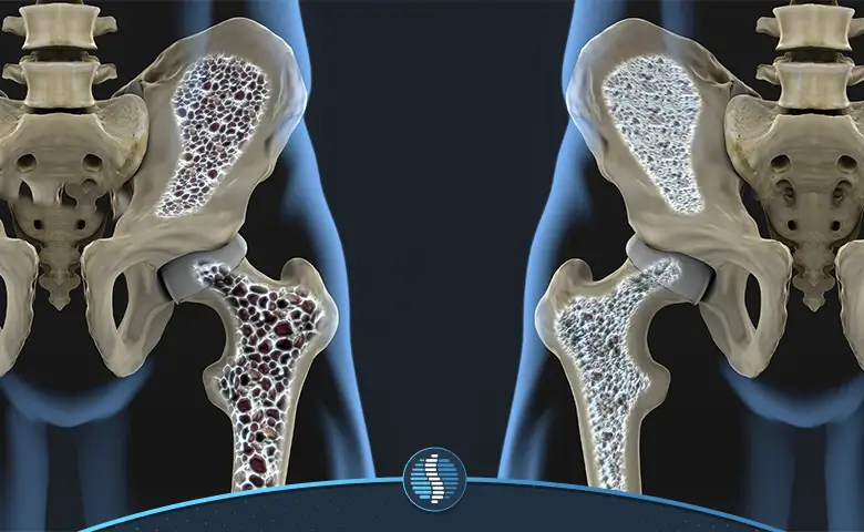درمان پوکی استخوان یک روش موثر برای جلوگیری از خطرات بیشتر|ژین طب