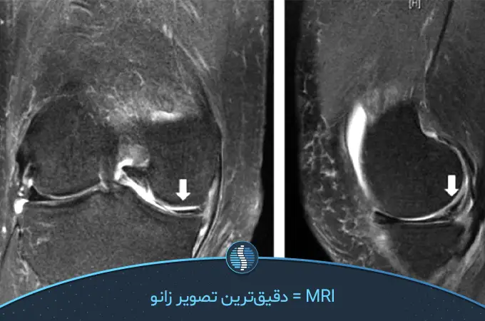 MRI مفصل زانو برای تشخیص طول درمان پارگی مینیسک زانو| ژین طب