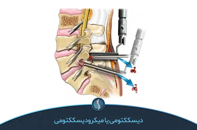 جراحی دیسککتومی‌؛ عمل جراحی دیسک کمر مهره 4 و 5|ژین طب