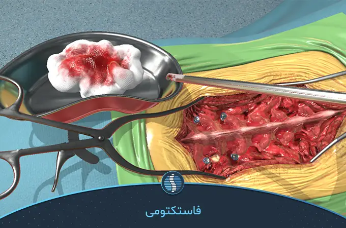 جراحی فاستکتومی که با بیهوشی در عمل دیسک کمر|ژین طب
