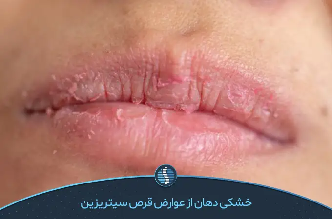 خشکی دهان، عوارض قرص سیتریزین برای بزرگسالان|ژین طب
