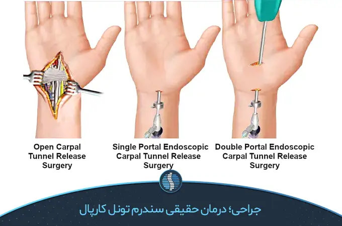 جراحی سندرم تونل کارپال دست|ژین طب