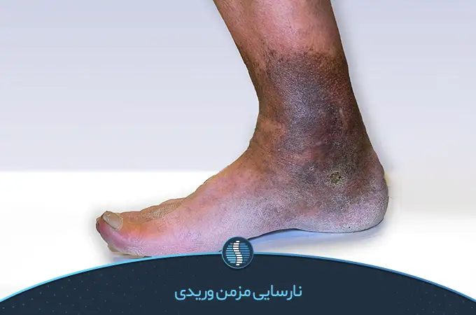 نارسایی مزمن وریدی علت درد پا از زانو به پایین پای چپ|ژین طب