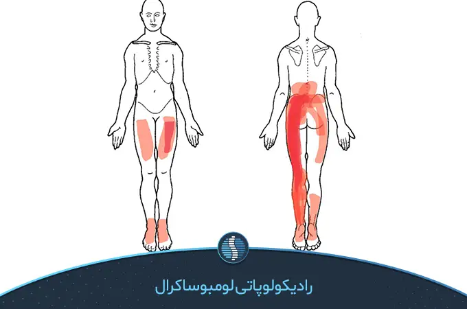 رادیکولوپاتی لومبوساکرال یا سیاتیک علت خستگی پاها از زانو به پایین|ژین طب