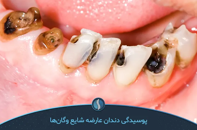 پوسیدگی دندان ناشی از رژیم خام گیاه خواری 20 روزه| ژین طب