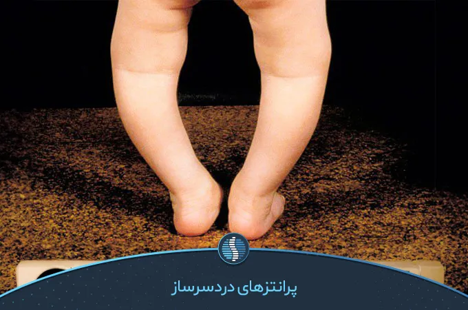 پای پرانتزی نوزاد انواع انحراف پا | ژین طب