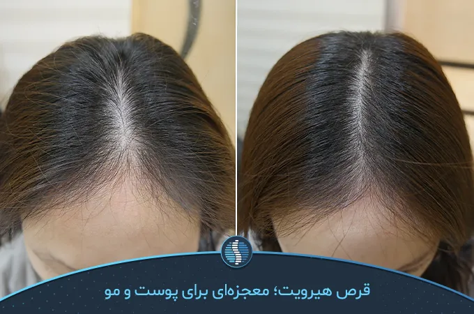 ریزش مو قبل و بعد از مصرف قرص هیرویت با رعایت بهترین زمان مصرف قرص هیرویت| ژین طب