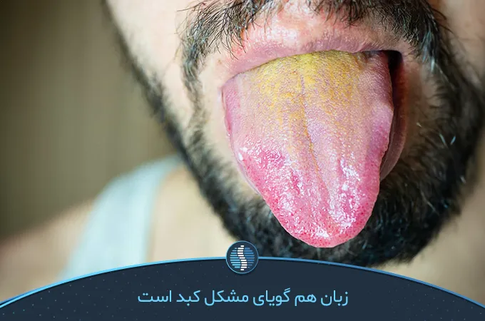 تشخیص کبد چرب از روی زبان|ژین طب