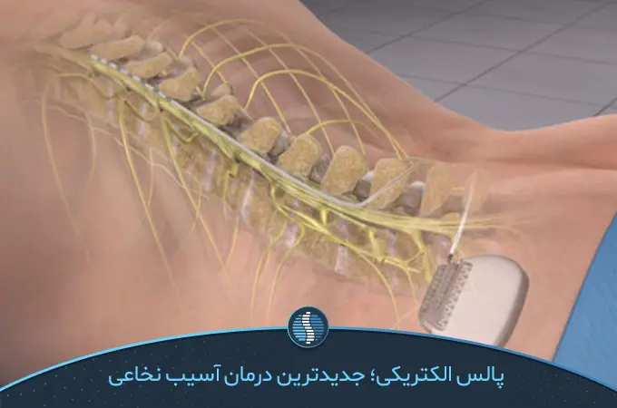 آناتومی ستون فقرات و نحوه قرارگیری دستگاه تحریک طناب نخاعی| ژین طب