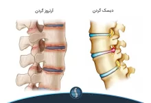 فرق دیسک گردن با آرتروز گردن چیست |ژین طب