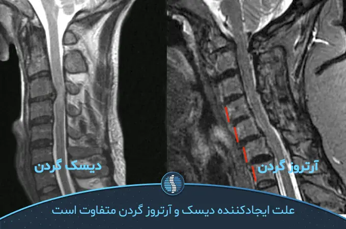 آیا بیماری دیسک گردن و آرتروز یکسان هستند؟|ژین طب