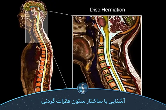 دیسک گردن چیست؟ آشنایی با ساختار خاص ستون مهره‌های گردنی|ژین طب