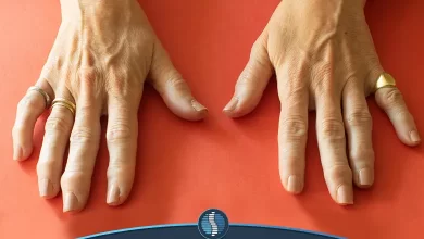 آشنایی با آرتروز انگشتان دست | ژین طب
