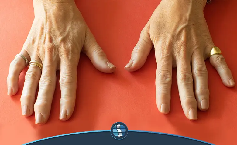 آشنایی با آرتروز انگشتان دست | ژین طب