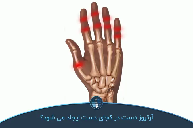 علت آرتروز انگشتان دست چیست؟ | ژین طب