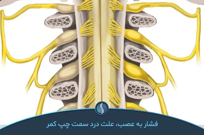 عصب فشرده شده و گیر افتاده بین مهره ها عامل درد کمر سمت چپ بالای لگن | ژین طب
